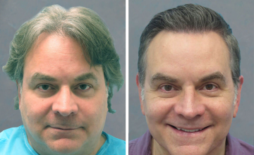 Norwood 4A 1,195 and 1,077 Grafts FUT - Dr. Robert Bernstein