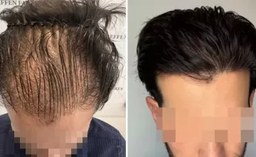 Before and After